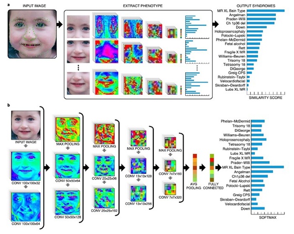 IA identifica doenças genéticas a partir da foto do rosto de uma pessoa
