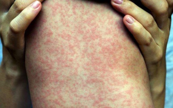 Casos de sarampo têm aumento de 300% no mundo, diz OMS