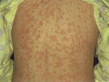 Manchas vermelhas pelo corpo podem aparecer em pessoas que contraíram sarampo