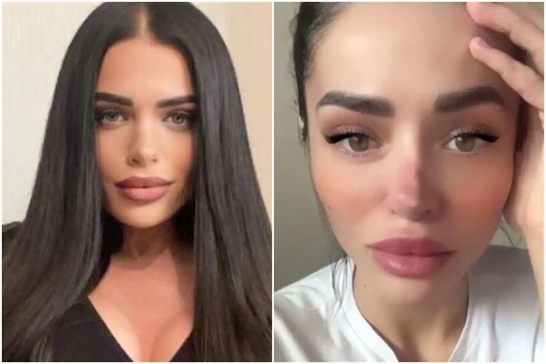 Reality Star saiu com nariz apodrecido após cirurgia plástica malsucedida e pede doações aos fãs