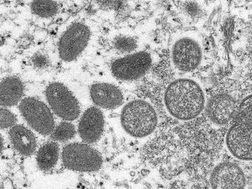 Disseminação da Varíola tem causado preocupação no mundo