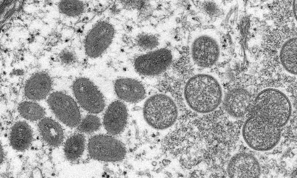Disseminação da Varíola tem causado preocupação no mundo