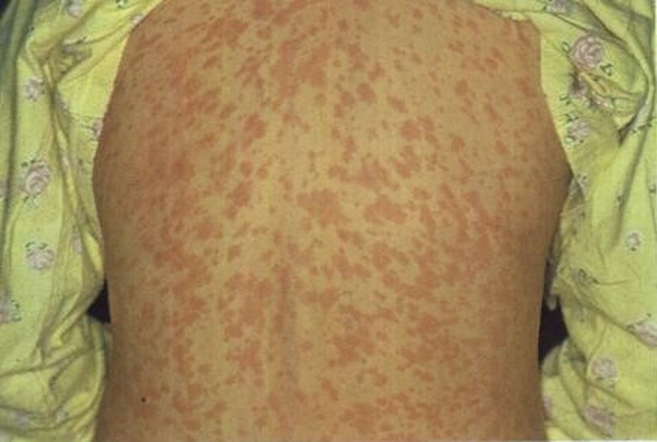 Manchas vermelhas pelo corpo podem aparecer em pessoas que contraíram sarampo